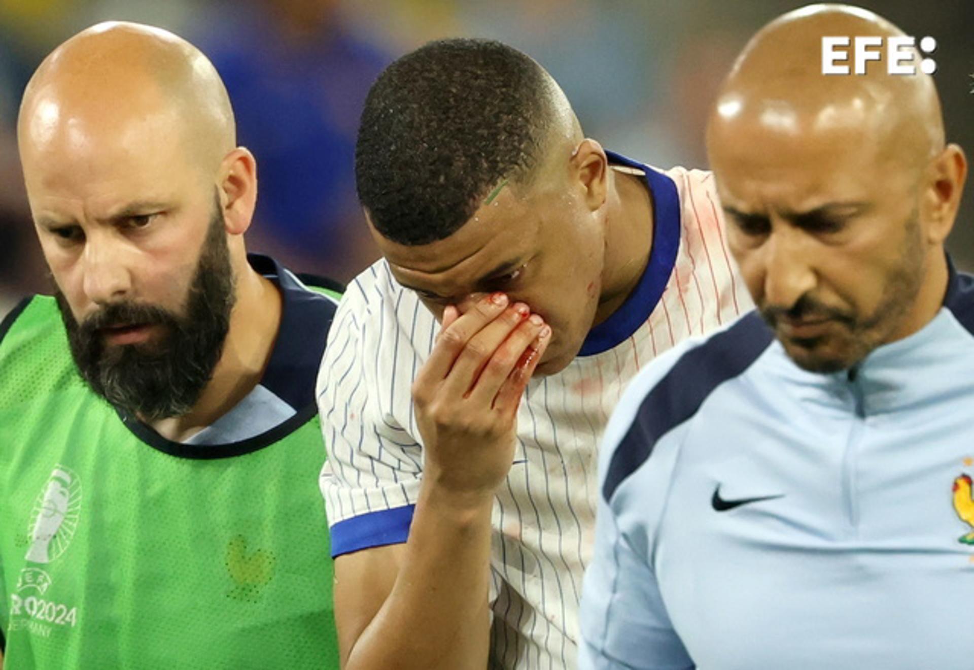 Mbappé se fractura la nariz, regresa a la concentración y jugará con máscara