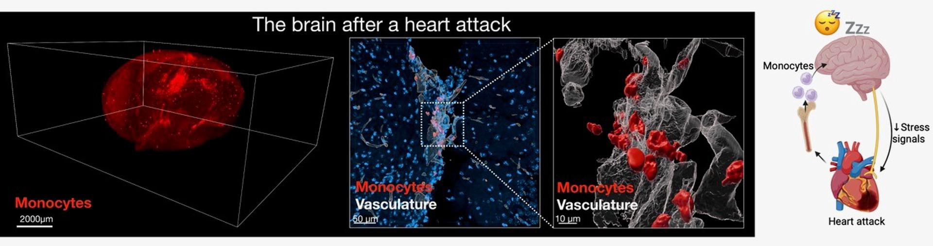 El corazón envía señales al cerebro para dormir más y mejorar recuperación tras un infarto